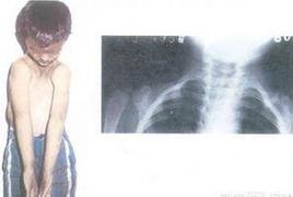 情感交叉擦腿綜合徵 情感交叉擦腿綜合徵