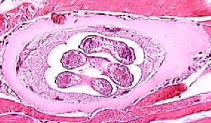 旋毛蟲病 旋毛蟲病