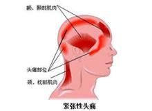 緊張性頭痛 緊張性頭痛