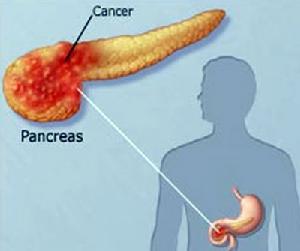 胰腺癌 胰腺癌