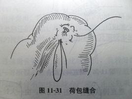 荷包縫合 荷包縫合