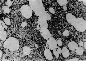 病毒性肺炎 病毒性肺炎