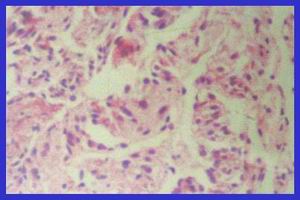 特發性肺含鐵血黃素沉著症