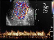 肝局灶性結節性增生