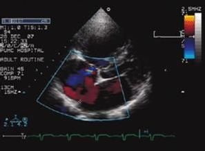 心臟彩超正常值