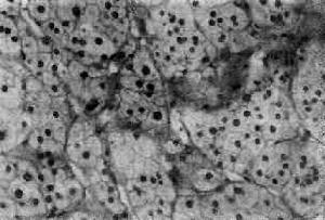 假性醛固酮減少症