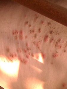 梅花康疹 梅花康疹