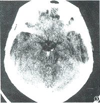 良性顱內壓增高