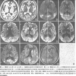 小兒病毒性腦膜炎