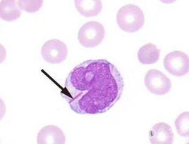 AUER小體 AUER小體