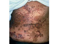 溶瘤綜合徵 溶瘤綜合徵