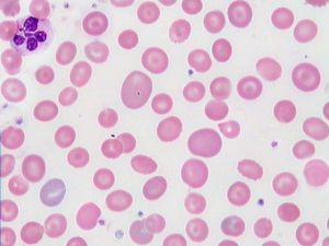 巨幼細胞性貧血