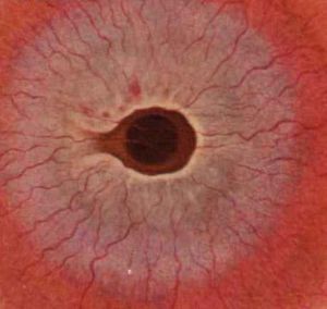 蠶蝕性角膜潰瘍