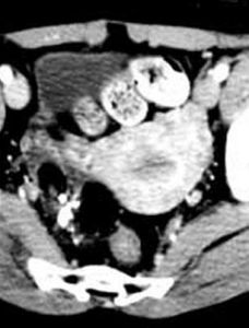 卵巢畸胎瘤 卵巢畸胎瘤