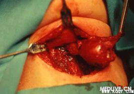 甲狀腺舌囊腫切除術 甲狀腺舌囊腫切除術