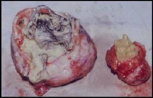 （圖）卵巢交界性腫瘤