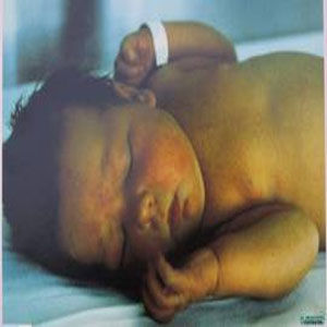 新生兒核黃疸 新生兒核黃疸