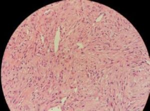 瀰漫性筋膜炎 瀰漫性筋膜炎