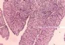 膀胱嗜鉻細胞瘤