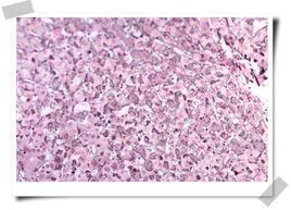 慢性活動性肝炎 慢性活動性肝炎