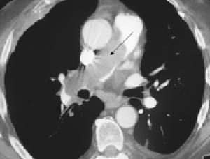 妊娠合併肺栓塞