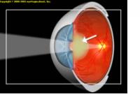 手足搐搦性白內障