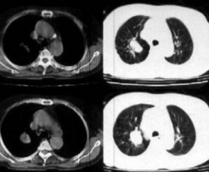 陳舊性病變 陳舊性病變