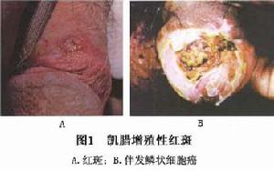 凱臘增殖性紅斑