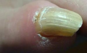 甲良性腫瘤 甲良性腫瘤