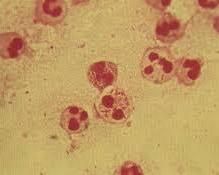 尿道炎症狀 尿道炎症狀