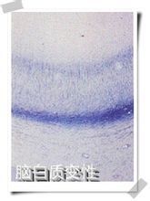 腦白質病變 腦白質病變