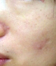 一位34歲女性皮膚減齡前的照片: