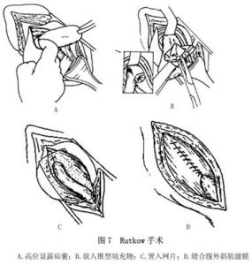 成人腹股溝斜疝