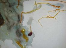 麥地那龍線蟲帶來疾病