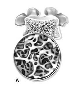 正常標準體內的骨小梁結構