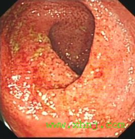 慢性潰瘍性結腸炎