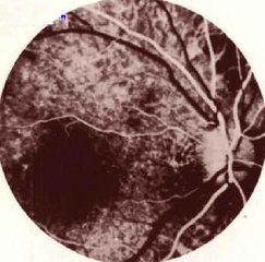 特發性息肉樣脈絡膜血管病變