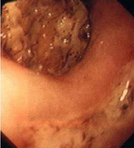 （圖）山楂結石
