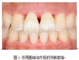 牙齦退縮 牙齦退縮