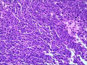 腱鞘巨細胞瘤 腱鞘巨細胞瘤