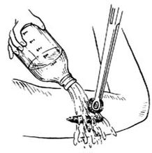 生理鹽水清理傷口