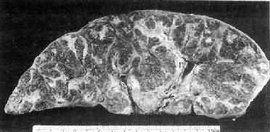 肝血吸蟲病 肝血吸蟲病