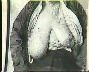 乳房絲蟲病 乳房絲蟲病