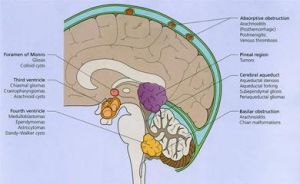 成神經細胞瘤 成神經細胞瘤