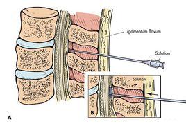 硬膜外麻醉 硬膜外麻醉