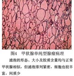 (圖)甲狀腺腺瘤