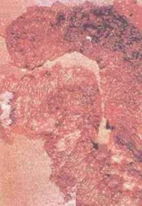 家族性多發性結腸息肉病