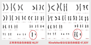 Klinefelter氏綜合症 Klinefelter氏綜合症