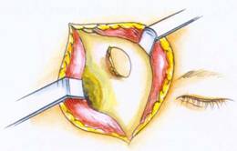 鼻部腦膜腦膨出