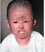 新生兒魚鱗病 新生兒魚鱗病